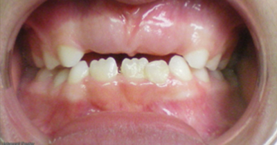 Before Orthodontic Treatments