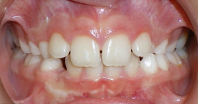 Before Orthodontic Treatment